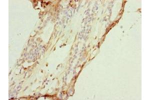 Immunohistochemistry of paraffin-embedded human breast cancer using ABIN7149183 at dilution of 1:100 (COX7A2L 抗体  (AA 1-114))