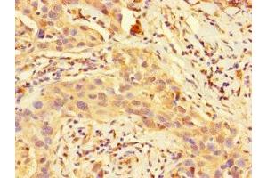Immunohistochemistry of paraffin-embedded human bladder tissue using ABIN7149795 at dilution of 1:100 (Destrin 抗体  (AA 2-165))