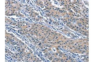 The image on the left is immunohistochemistry of paraffin-embedded Human gastric cancer tissue using ABIN7130004(KLF7 Antibody) at dilution 1/60, on the right is treated with fusion protein. (KLF7 抗体)