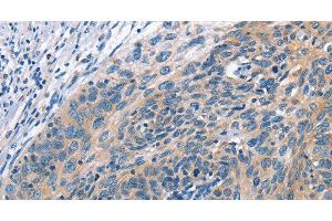 Immunohistochemistry of paraffin-embedded Human cervical cancer tissue using CUL7 Polyclonal Antibody at dilution 1:50 (Cullin 7 抗体)