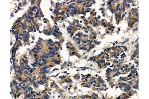 ABIN7097113 and ABIN7101180 at 1/100 staining human colorectal cancer by IHC-P.