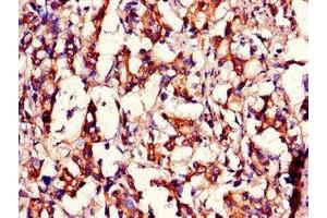 Immunohistochemistry of paraffin-embedded human gastric cancer using ABIN7159104 at dilution of 1:100 (MED12 抗体  (AA 1742-2011))