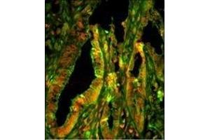 Immunofluorescence analysis of CZA1 Antibody (N-term) with paraffin-embedded human prostate carcinoma tissue. (CAPZA1 抗体  (N-Term))