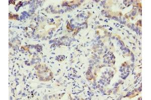 Immunohistochemistry of paraffin-embedded human lung cancer using ABIN7157372 at dilution of 1:100 (Cytokeratin 1 抗体  (AA 1-584))