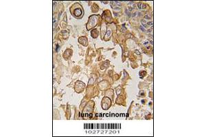 Formalin-fixed and paraffin-embedded human lung carcinoma tissue reacted with Mouse TLR6 antibody , which was peroxidase-conjugated to the secondary antibody, followed by DAB staining. (TLR6 抗体  (C-Term))