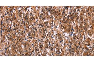 Immunohistochemistry of paraffin-embedded Human gasrtic cancer tissue using LILRB1 Polyclonal Antibody at dilution 1:50 (LILRB1 抗体)