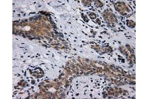 Immunohistochemical staining of paraffin-embedded breast tissue using anti-SIL1 mouse monoclonal antibody. (SIL1 抗体)