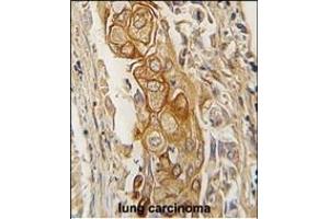 Formalin-fixed and paraffin-embedded human lung carcinoma tissue reacted with AC antibody (C-term) (ABIN391855 and ABIN2841687) , which was peroxidase-conjugated to the secondary antibody, followed by DAB staining. (ACPP 抗体  (C-Term))