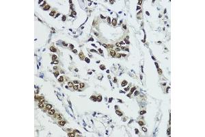 Immunohistochemistry of paraffin-embedded human lung cancer using Phospho-Histone H3-T11 antibody (ABIN3023615, ABIN3023616, ABIN3023617 and ABIN6225469) at dilution of 1:100 (40x lens). (Histone 3 抗体  (pThr11))