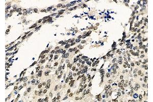 ABIN6259614 and ABIN6275390 at 1/100 staining Human ovarian cancer by IHC-P. (Pre-mRNA Branch Site Protein p14 (SF3B14) (C-Term) 抗体)