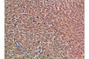 Immunohistochemical analysis of paraffin-embedded human-liver-cancer, antibody was diluted at 1:200 (Chordin 抗体  (AA 905-954))