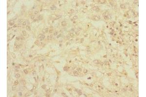 Immunohistochemistry of paraffin-embedded human pancreatic cancer using ABIN7174780 at dilution of 1:100 (C1ORF127 抗体  (AA 401-648))
