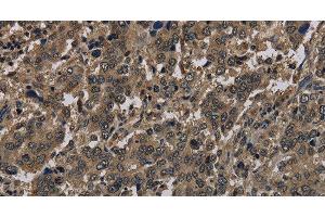 Immunohistochemistry of paraffin-embedded Human liver cancer using Histone H4 Polyclonal Antibody at dilution of 1:30 (Histone H4 抗体)