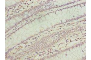 Immunohistochemistry of paraffin-embedded human colon cancer using ABIN7173167 at dilution of 1:100 (TMEM243 抗体  (AA 1-31))