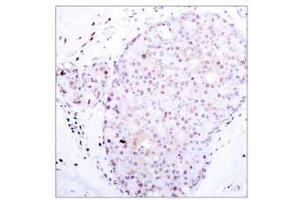 Immunohistochemical analysis of paraffin-embedded human breast carcinoma, using NF-κB p105/p50 (Ab-907) antibody (E021019). (NFKB1 抗体)