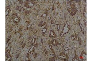 Immunohistochemistry (IHC) analysis of paraffin-embedded Human Breast Caricnoma using Phosphoserine Mouse mAb diluted at 1:200. (Phosphoserine 抗体  (phosphorylated))