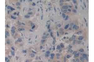 Detection of PIK3C3 in Human Breast cancer Tissue using Polyclonal Antibody to Phosphoinositide-3-Kinase Class 3 (PIK3C3) (PIK3C3 抗体  (AA 631-885))