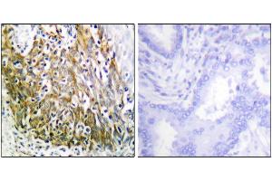 Iunohistochemistry analysis of paraffin-embedded human lung carcinoma tissue using P-10 antibody. (MMP10 抗体)