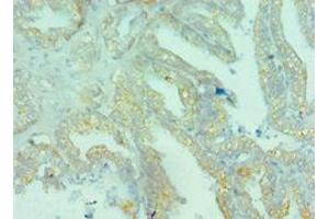 Immunohistochemistry of paraffin-embedded human bladder cancer using ABIN7145824 at dilution of 1:100 (BRD9 抗体  (AA 338-597))