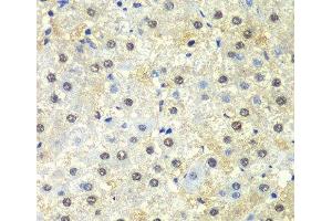 Immunohistochemistry of paraffin-embedded Human liver damage using PSMD13 Polyclonal Antibody at dilution of 1:100 (40x lens). (PSMD13 抗体)