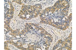 RXFP1 Mouse Monoclonal Antibody at 1/100 staining human lung cancer and adjacent non-tumor tissue by IHC-P. (RXFP1 抗体  (Internal Region))