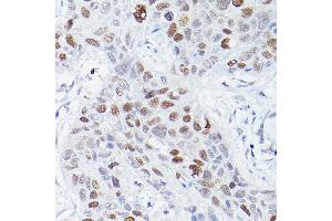 Immunohistochemistry of paraffin-embedded human lung squamous carcinoma tissue using RBPJK Rabbit mAb (ABIN1682563, ABIN3018511, ABIN3018512 and ABIN7101620) at dilution of 1:50 (40x lens). (RBPJ 抗体)