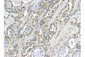 TXNDC6 Antibody at 1/100 staining human ovarian cancer by IHC-P.