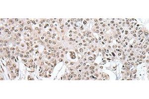 Immunohistochemistry of paraffin-embedded Human prost ate cancer tissue using HNRNPH2 Polyclonal Antibody at dilution of 1:40(x200) (HNRNPH2 抗体)