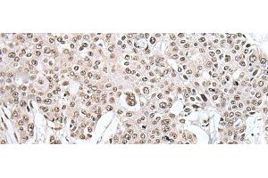 Immunohistochemistry of paraffin-embedded Human prost ate cancer tissue using HNRNPH2 Polyclonal Antibody at dilution of 1:40(x200) (HNRNPH2 抗体)
