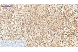 Immunohistochemistry of paraffin-embedded Human breast cancer tissue using XRCC4 Monoclonal Antibody at dilution of 1:200. (XRCC4 抗体)