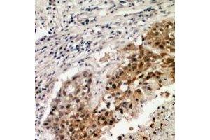 Immunohistochemical analysis of VEGFR3 staining in human lung formalin fixed paraffin embedded tissue section.