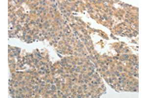 The image on the left is immunohistochemistry of paraffin-embedded Human liver cancer tissue using ABIN7189581(ABCB11 Antibody) at dilution 1/25, on the right is treated with synthetic peptide.