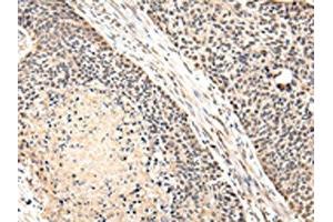 The image on the left is immunohistochemistry of paraffin-embedded Human esophagus cancer tissue using ABIN7131587(VPS41 Antibody) at dilution 1/20, on the right is treated with fusion protein. (VPS41 抗体)