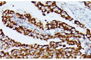 Immunohistochemistry of paraffin-embedded Human thyroid cancer using IDH3A Polyclonal Antibody at dilution of 1:100 (40x lens). (IDH3A 抗体)
