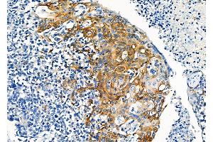 ABIN6264379 and ABIN6277166 at 1/100 staining Human pancreatic cancer by IHC-P.