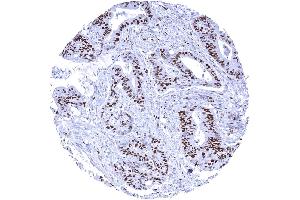 Colorectal adenocarcinoma with a large fraction of MCM7 positive tumor cells (Recombinant MCM7 抗体  (AA 195-319))