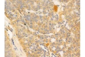 ABIN6259847 and ABIN6277044 at 1/100 staining human ovarian carcinoma by IHC-P.