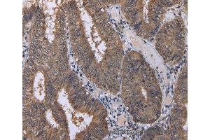 Immunohistochemistry of Human colon cancer using CUL3 Polyclonal Antibody at dilution of 1:30 (Cullin 3 抗体)