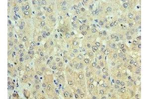 Immunohistochemistry of paraffin-embedded human liver cancer using ABIN7143649 at dilution of 1:100 (ADH1C 抗体  (AA 1-375))