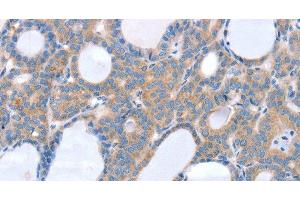 Immunohistochemistry of paraffin-embedded Human thyroid cancer using SLC25A13 Polyclonal Antibody at dilution of 1:35 (slc25a13 抗体)
