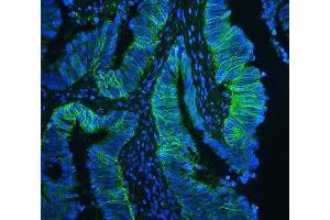 IF analysis of CD147/Emmprin using anti-CD147/Emmprin antibody (ABIN5518743) CD147/Emmprin was detected in paraffin-embedded section of human intestinal cancer tissues. (CD147 抗体  (AA 138-323))