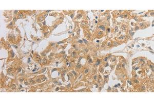 Immunohistochemistry of paraffin-embedded Human lung cancer tissue using HCRTR2 Polyclonal Antibody at dilution 1:50 (HCRTR2 抗体)