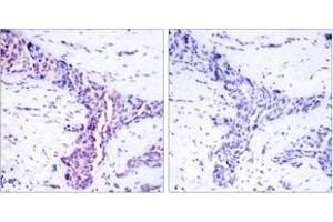 Immunohistochemistry analysis of paraffin-embedded human breast carcinoma tissue, using ATF2 (Ab-73 or 55) Antibody. (ATF2 抗体  (AA 40-89))