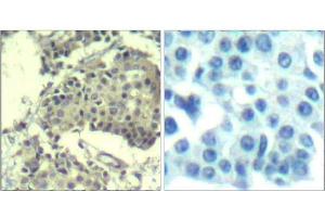 Immunohistochemical analysis of paraffin-embedded human breast carcinoma tissue using mTOR (Ab-2481) Antibody (E021515). (MTOR 抗体)