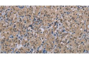 Immunohistochemistry of paraffin-embedded Human thyroid cancer tissue using MGLL Polyclonal Antibody at dilution 1:40 (MGLL 抗体)