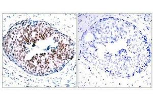 Immunohistochemical analysis of paraffin-embedded human breast carcinoma tissue using STAT5A(Phospho-Ser780) Antibody(left) or the same antibody preincubated with blocking peptide(right). (STAT5A 抗体  (pSer780))