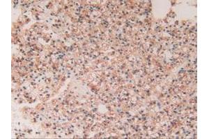 IHC-P analysis of Human Kidney Cancer Tissue, with DAB staining. (GAA 抗体  (AA 595-770))