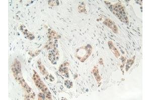 Detection of HMGB1 in Human Breast cancer Tissue using Polyclonal Antibody to High Mobility Group Protein 1 (HMGB1) (HMGB1 抗体  (AA 1-215))