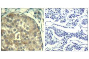 Immunohistochemical analysis of paraffin-embedded human breast carcinoma tissue using cofilin1/cofilin2(Phospho-Tyr88) Antibody(left) or the same antibody preincubated with blocking peptide(right). (Cofilin1/2 (CFL1/2) (pTyr88) 抗体)
