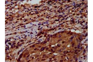 IHC image of ABIN7151198 diluted at 1:600 and staining in paraffin-embedded human lung cancer performed on a Leica BondTM system. (RNF43 抗体  (AA 566-697))